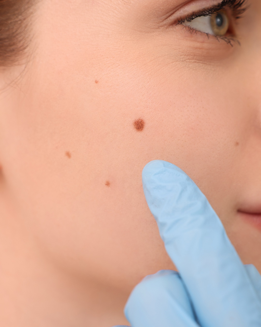 doctor del melanoma